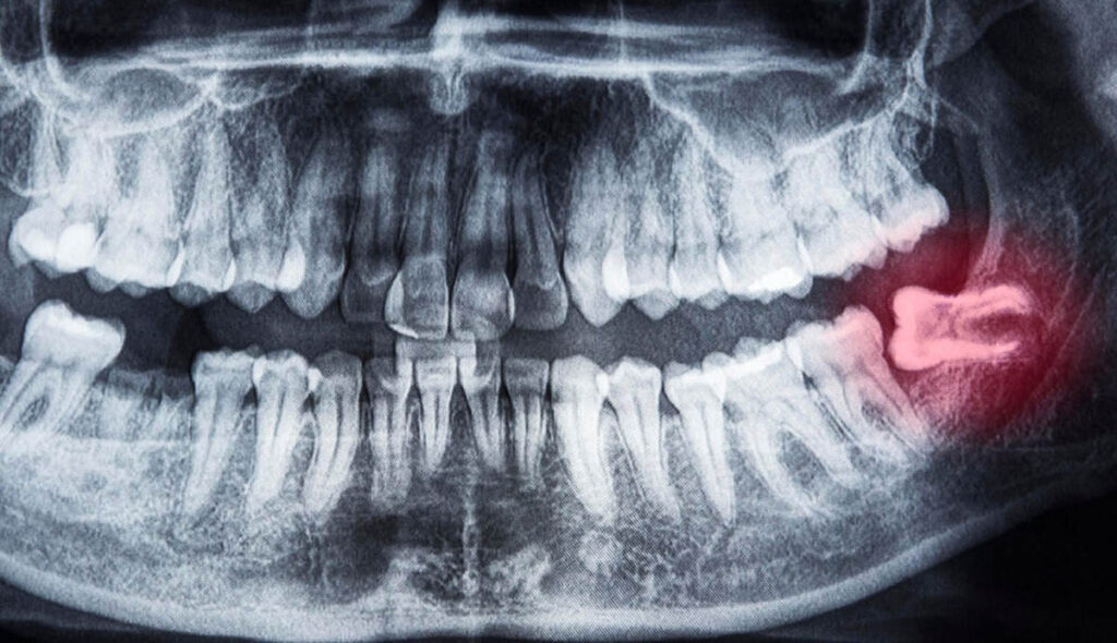 dente incluso